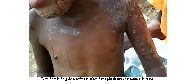 Une épidémie de gale en Haïti